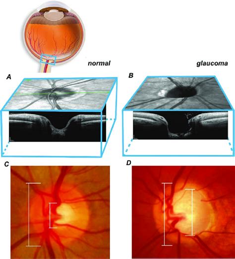 Structural Damage To Optic Nerve Head In Glaucoma Imaged By Optical