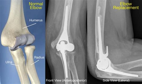 Shoulder And Elbow Replacement Dr Yash Shah