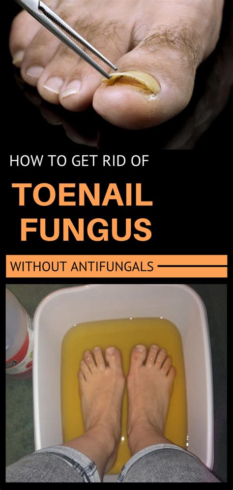 How To Get Rid Of Toenail Fungus Without Antifungals
