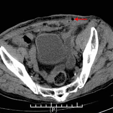Pelvic Ct Scans Showed That The Subcutaneous Fat Space In The Wound