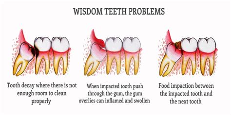 However, you can leave the dentist's office soon after the surgery is complete. Remove Wisdom Teeth With Deivam Dental Clinic - Health ...