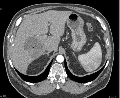 Abscess In The Gall Bladder Fossa Liver Case Studies Ctisus Ct Scanning