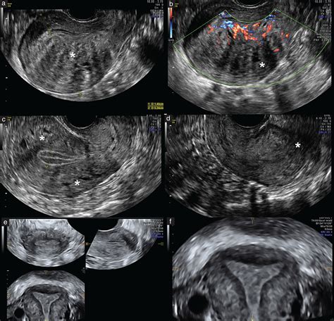 Transvaginal Sonographic Features Of Diffuse Adenomyosis In 1830‐year