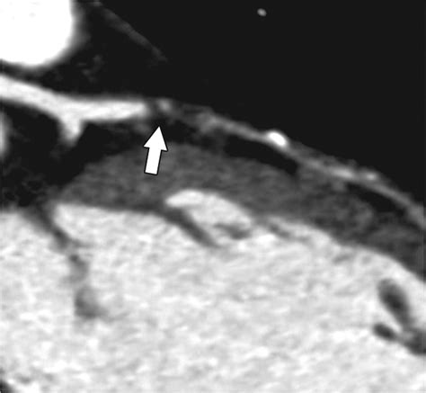 Ct Of Coronary Artery Disease Radiology