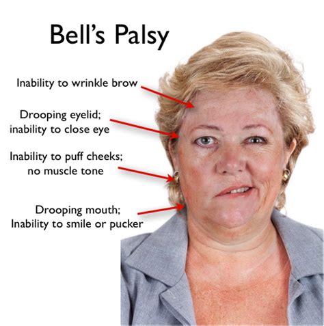 Bell S Palsy Treatment Higgibt