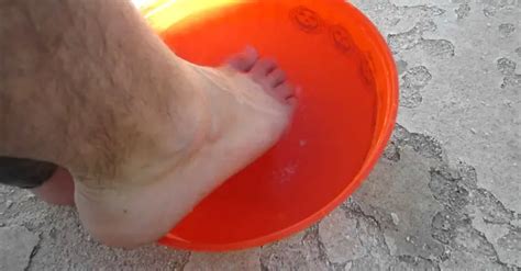 10 Natural Remedies To Get Rid Of Fungal Infection Between Toes