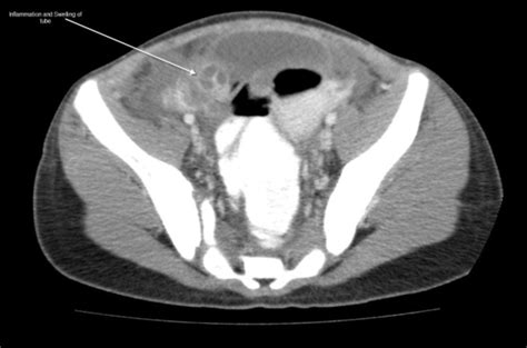 Ct Scan Of The Abdomen And Pelvis With Intravenous And Oral Contrast A