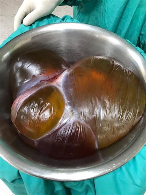 Kalau ada cyst, fibroid boleh ambil produk ni. Wanita Ni Ingatkan Mengandung, Rupanya Ada Cyst. Bukan ...