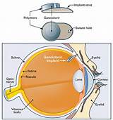 Scleral Buckle Surgery Recovery