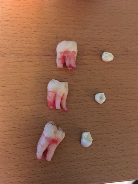 Wisdom Teeth Got Removed This Morning Heres A Size Comparison Between