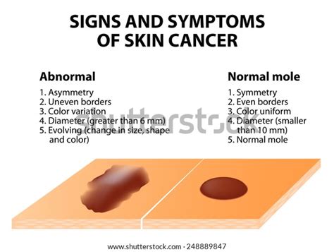 Skin Cancer Signs And Symptoms Pictures Idaman