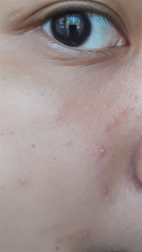 Skin Concern Acne Like Reactionrash On The Face Does Anyone Have