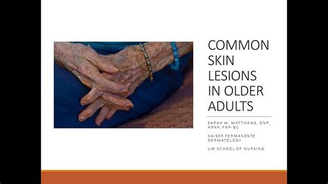 common skin lesions in older adults youtube
