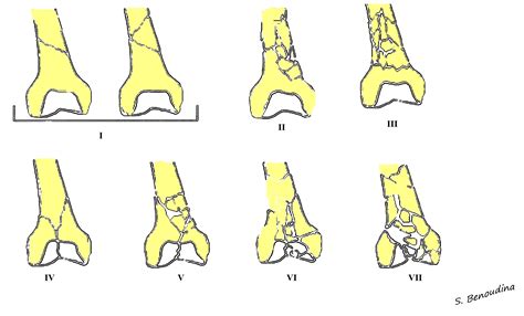 Analyzed 92 patients from 1992 to 2009, with. Distal femoral fractures: SOFCOT classification | Image ...
