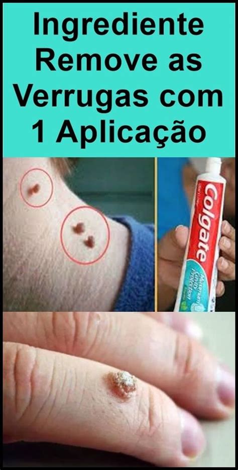 Ainda não temos dados sobre valter artistico, se você conhece alguma coisa, colabore com nossa comunidade eviando as informações agora mesmo! Receita Com Pasta de Dente Para Remover Verrugas! em 2020 | Remover verrugas, Dicas para ...