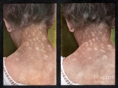 Rash Caused By Syphilis Vintage Photograph By Doublevision Fine Art