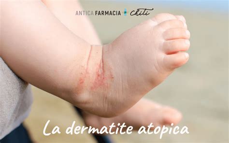 La dermatite atopica cos è e come curarla