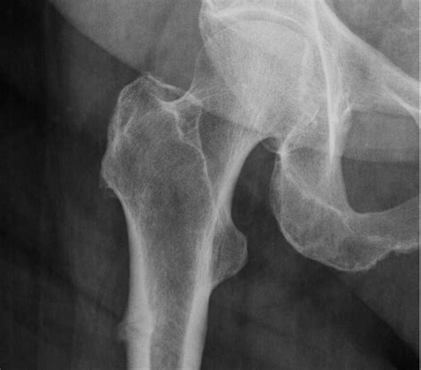 Increased Risk For Atypical Femur Fracture With Longer Bisphosphonate