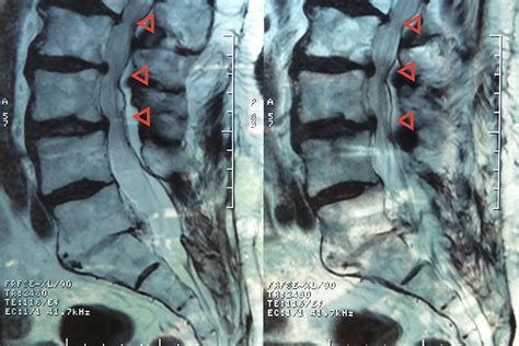 La cirugía mejora la estenosis de canal lumbar en acondroplasia