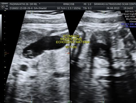 Fetal Stomach Ultrasound
