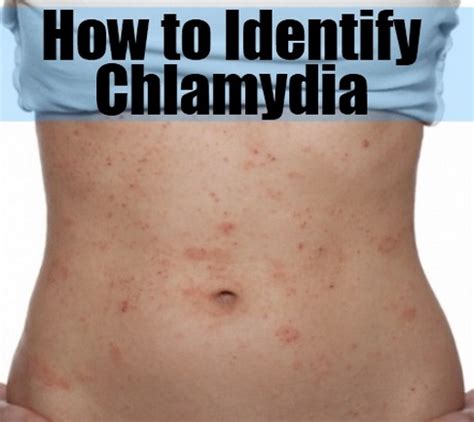 Check spelling or type a new query. Chlamydia - Ty też bądź zdrowy jak ryba