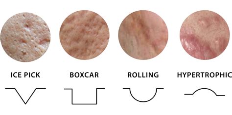 Types Of Acne Scars Types Of Acne Scars And How To Treat Them