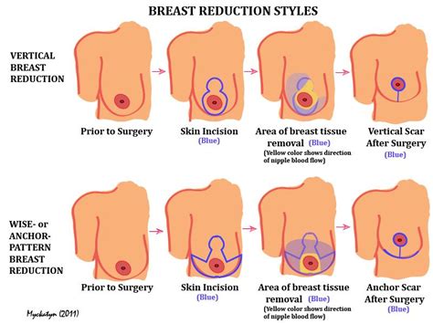 Breast Reduction Faqs Washington University Physician
