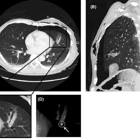 Axial A And Sagittal B Contrast Enhanced Computed Tomography Images