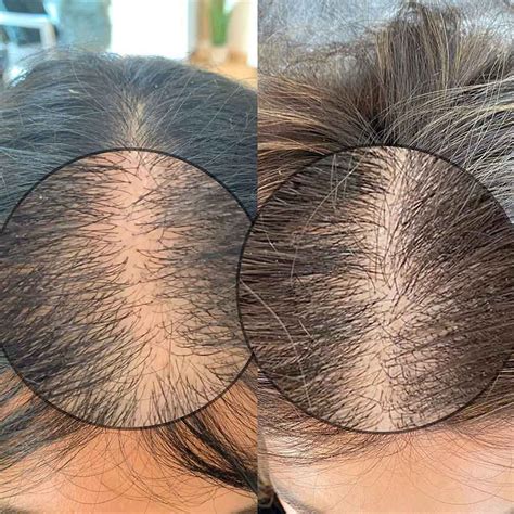 Top Dermaroller For Hair Growth Results Polarrunningexpeditions