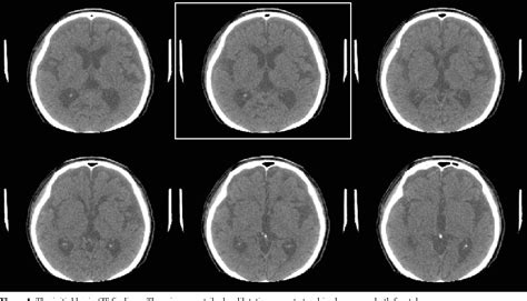 Figure 1 From Dementia Caused By Post Traumatic Hydrocephalus Showing