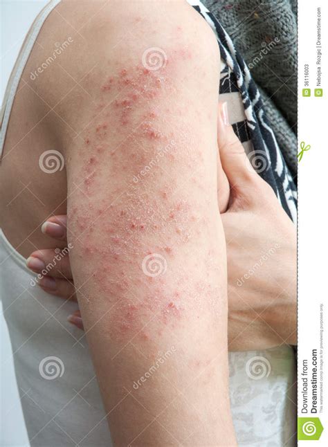 Allergic Rash Dermatitis Stock Image Image Of Detail 36116003