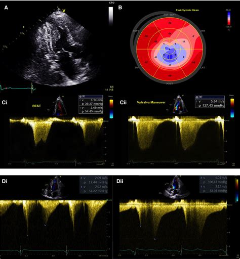 Apical Hypertrophic Cardiomyopathy The Variant Less Known Journal Of