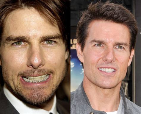 Tom Cruise Teeth Before After Tom Cruises Dental Transformation The
