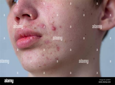 A Picture Of Acne On The Face Of A Teenager Pimples Red Scars And
