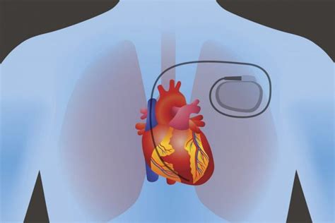 Living With A Pacemaker Facty Health