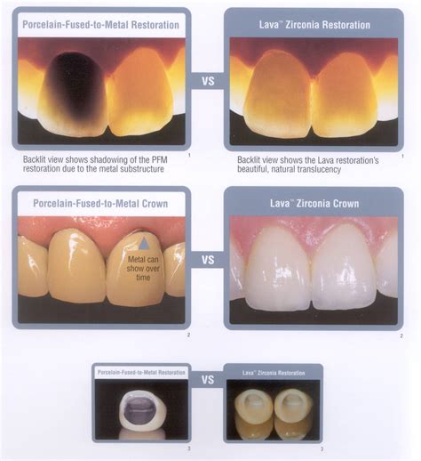 Zirconia Crowns Before And After Dr Ari Greenspan Dentist
