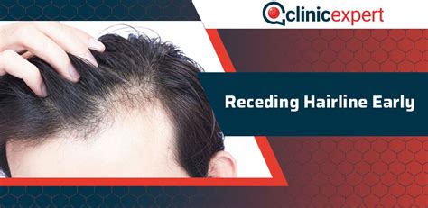 Receding Hairline Stages Signs Treatment