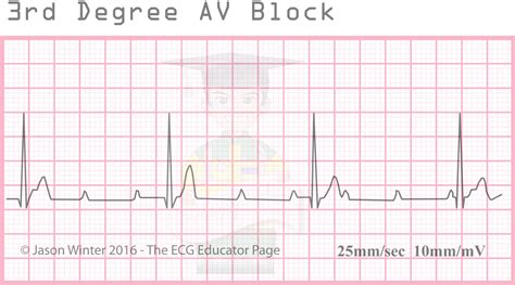 3rd Degree Heart Block Photos Idea