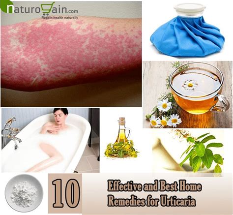 10 Effective And Best Home Remedies For Urticaria Urticaria Home