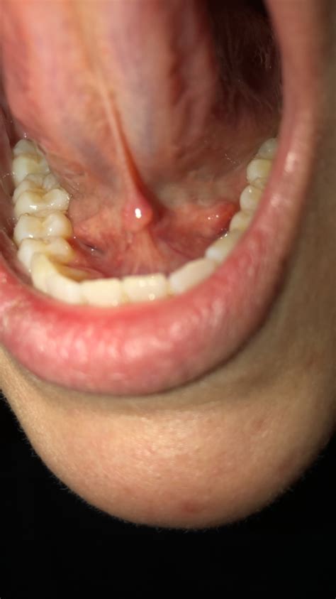 Bumps Under Tongue Oral And Dental Problems Forums