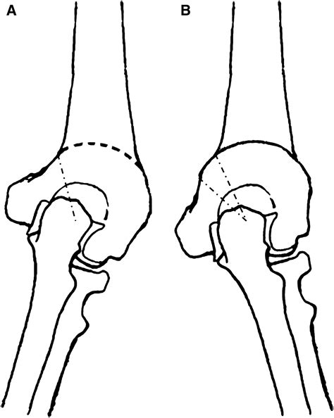 Corrective Dome Osteotomy For Cubitus Varus And Valgus In Adults