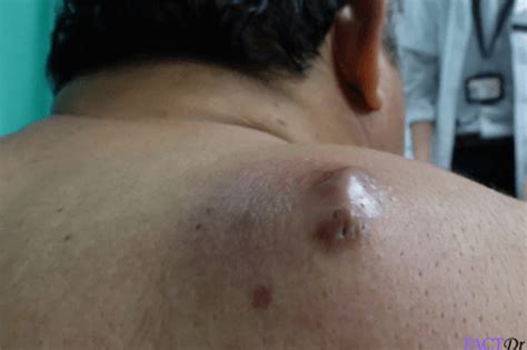 Sebaceous Cyst Removal Treatment And Safe Draining Factdr 2022