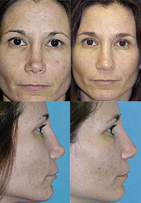 What To Do After A Bad Rhinoplasty Experience David A