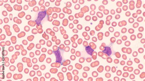 Photomicrograph Of Peripheral Blood Smear Showing Atypical Lymphocytes