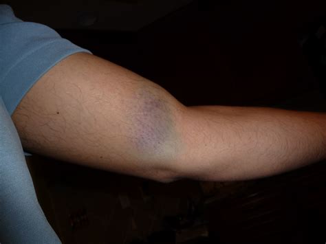 Upper Arm Bicep Pain Submited Images Pic2fly