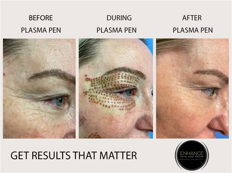 Plasma Pen Fibroblasting Skin Tightening Treatment Dr Brian Windle