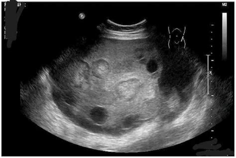 Image Of The Week Crampy Abdominal Pain Distension And Bloating