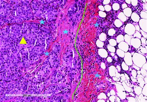 This Case Of Breast Cancer Metastasis Illustrates The Compartments