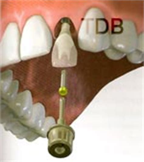 Straumann CADCAM abutment Bangkok and customized abutment ...