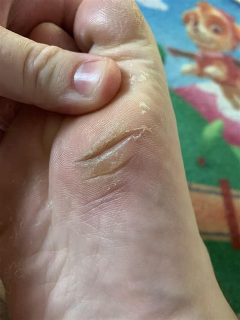 any id on what this split is and why how i can prevent it i use moisturizer every night and